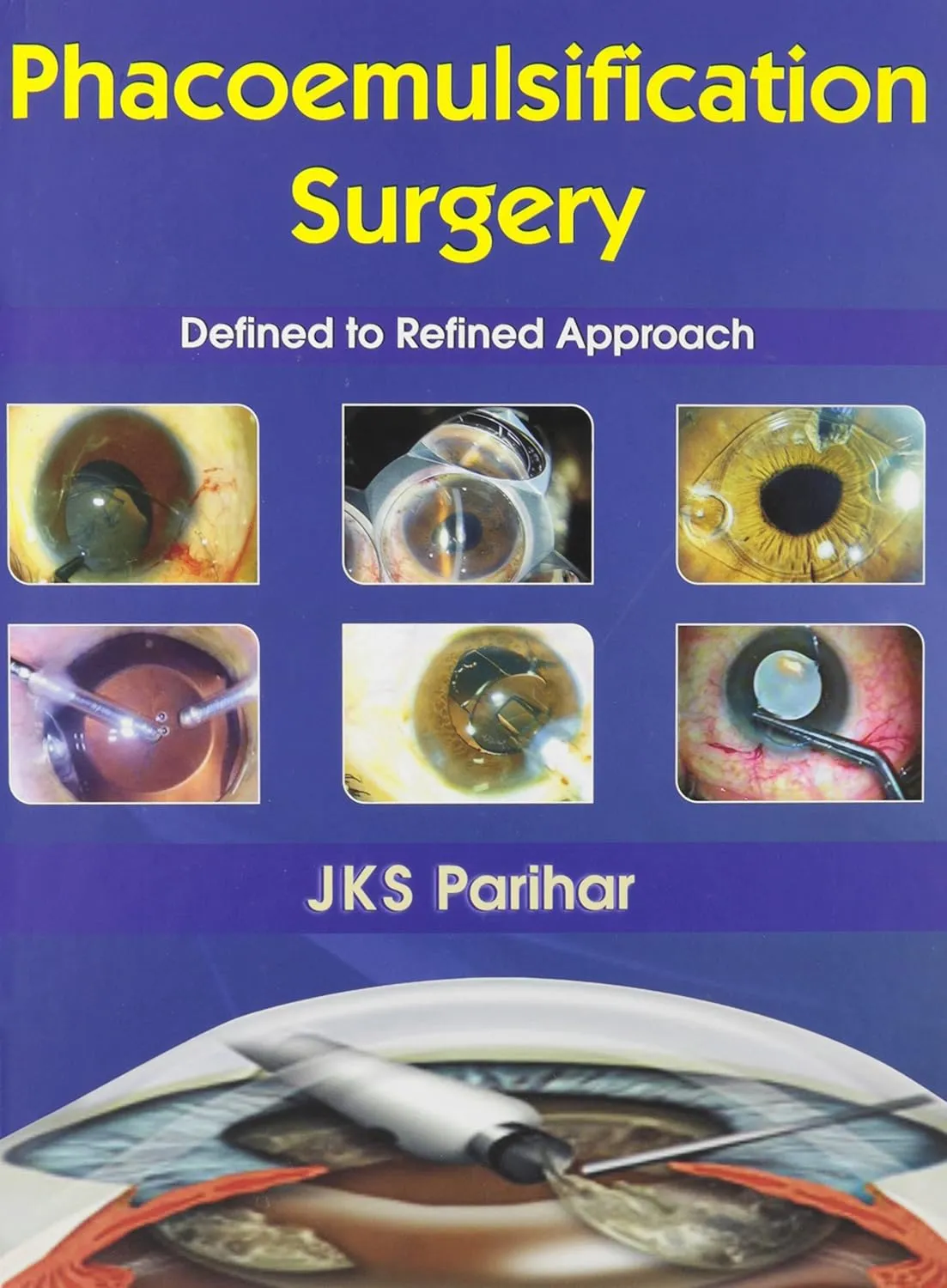 Phacoemuslification Surgery Defined to Refined Approach | Hardcover