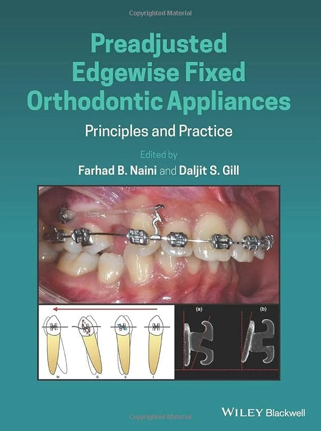 Preadjusted Edgewise Fixed Orthodontic Appliances Principles And Practice | Hardcover