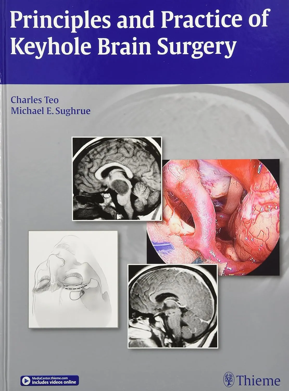 Principles and Practice of Keyhole Brain Surgery | Hardcover