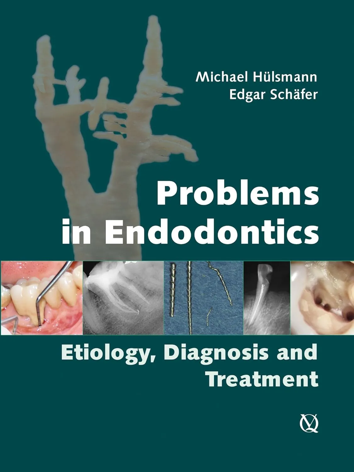 Problems in Endodontics Ediology | Diagnosis and Treatment | Hardcover