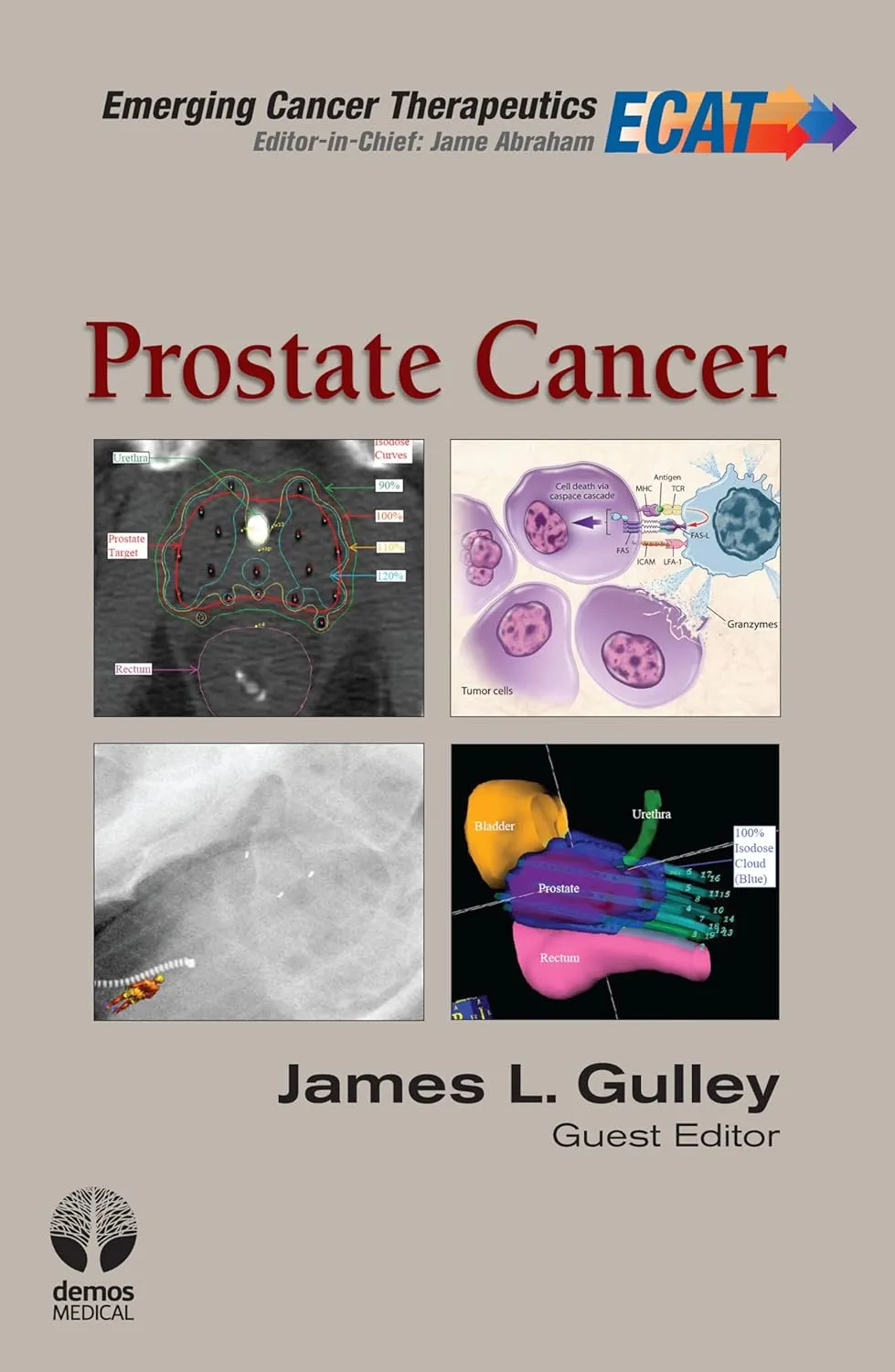 Prostate Cancer | Hardcover