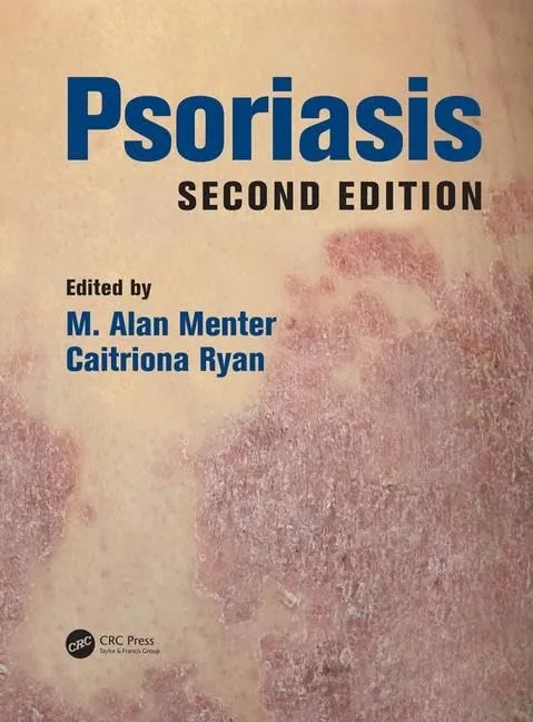 Psoriasis | 2nd Edition | Hardcover