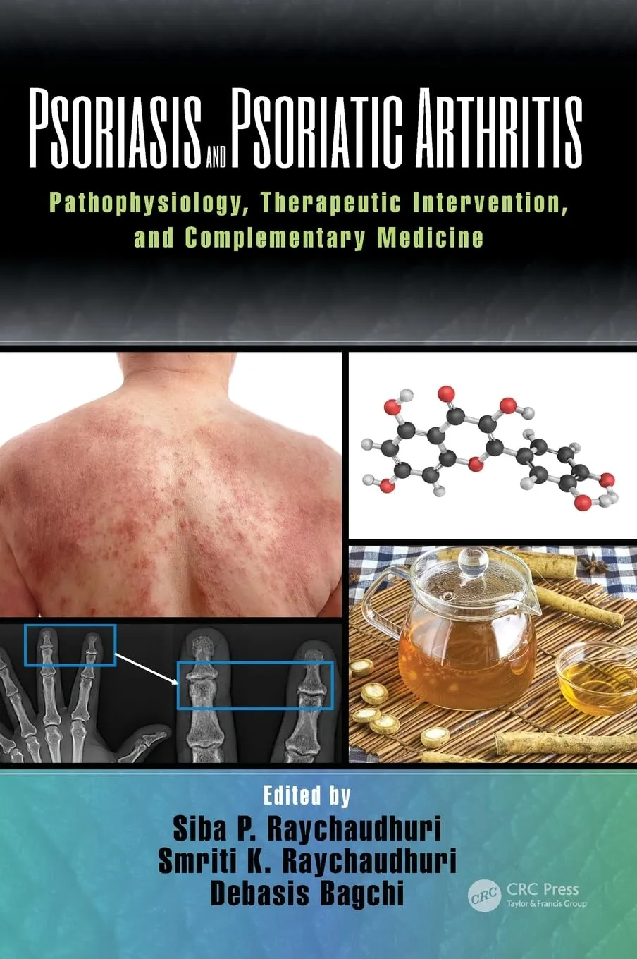 Psoriasis and Psoriatic Arthritis | Hardcover