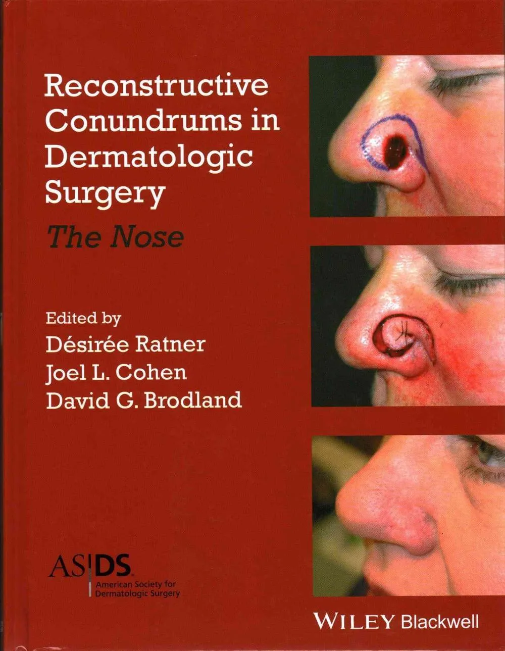Reconstructive Conundrums in Dermatologic Surgery The Nose | Hardcover