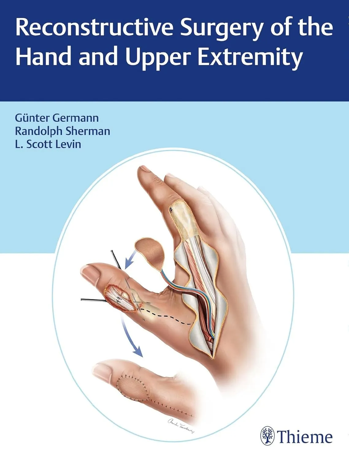 Reconstructive Surgery of the Hand and Upper Extremity | Hardcover