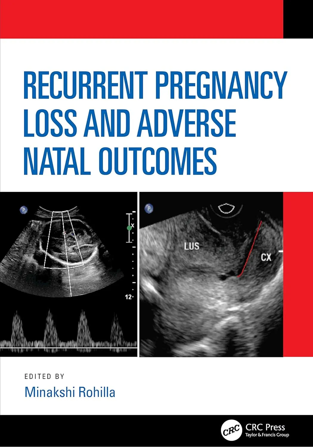 Recurrent Pregnancy Loss And Adverse Natal Outcomes | Hardcover