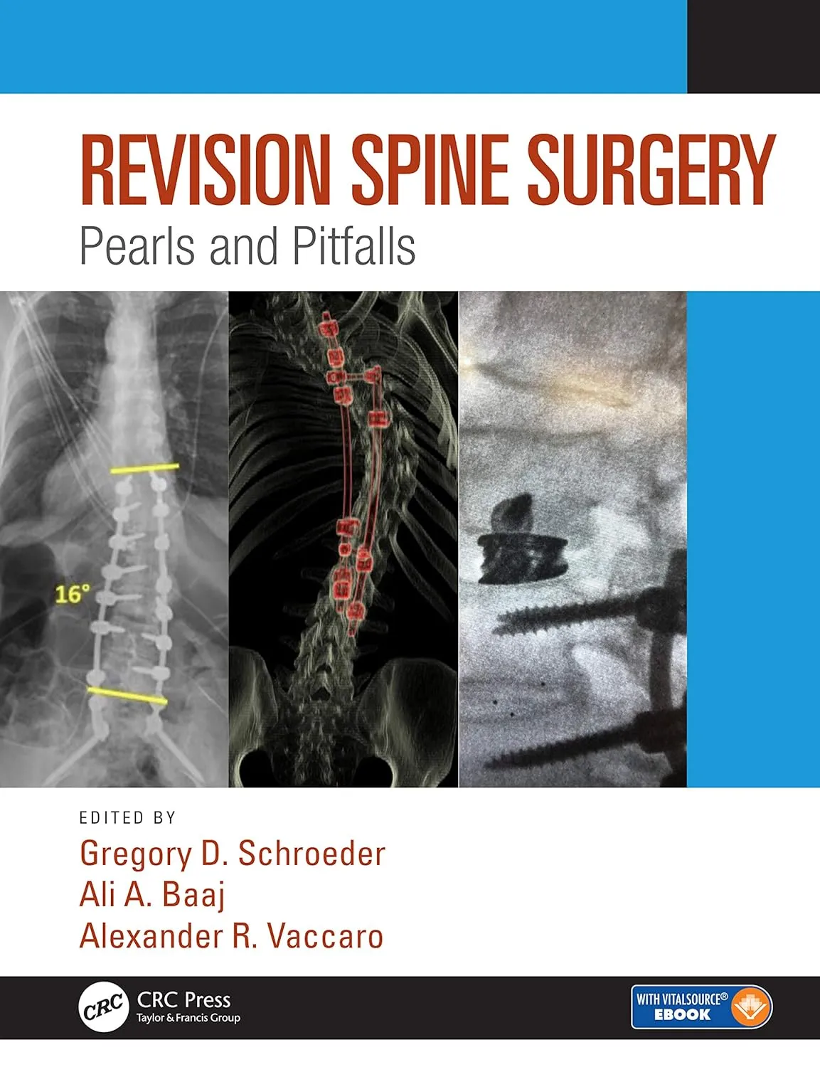 Revision Spine Surgry Pearls and Pitfalls | Hardcover