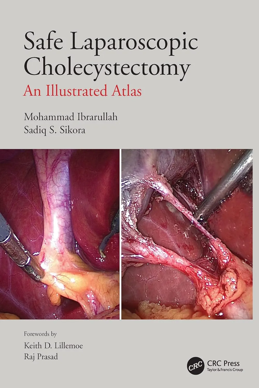 Safe Laparoscopic Cholecystectomy An Illustrated Atlas | Paperback