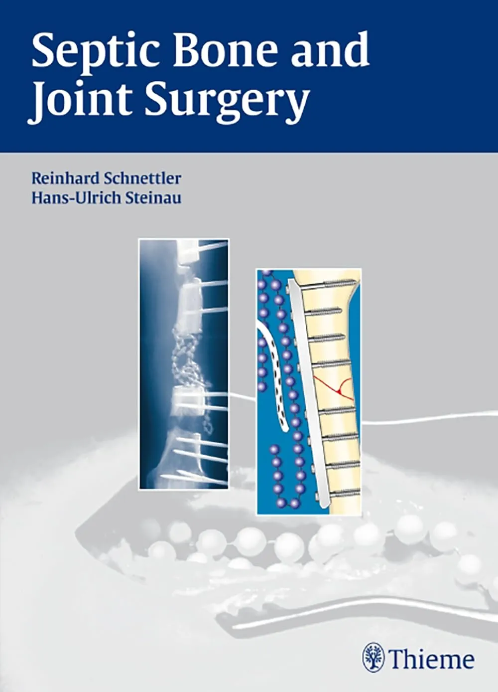 Septic Bone and Joint Surgery | Hardcover