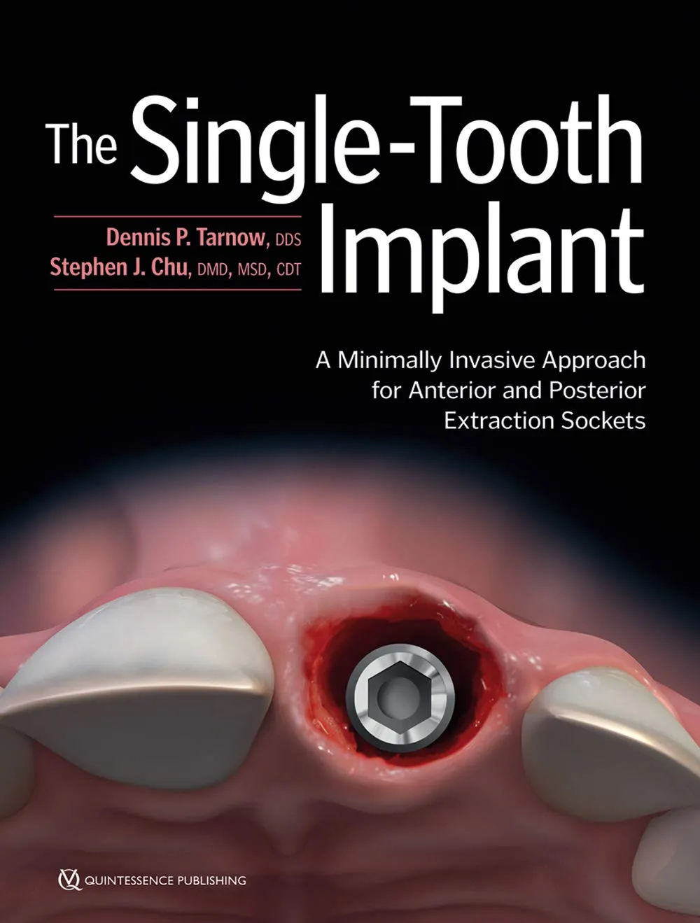 The Single-Tooth Implant A Minimally Invasive Approach for Anterior and Posterior Extraction Sockets | Hardcover