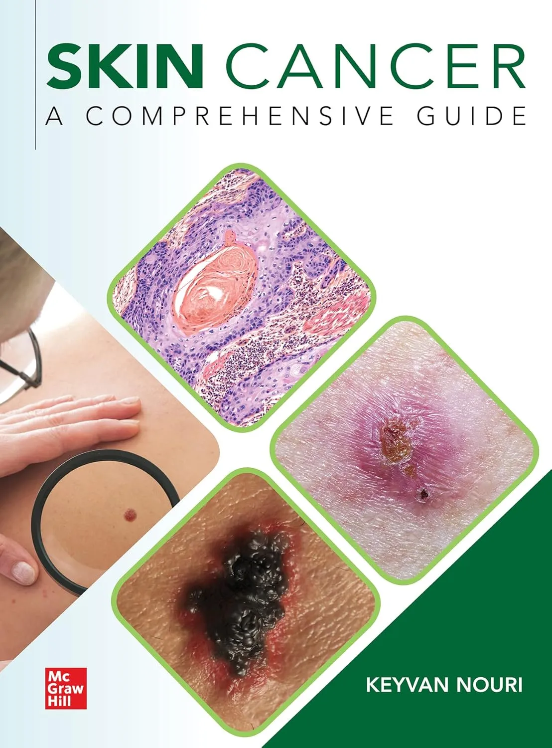 Skin Cancer A Comprehensive Guide | Hardcover