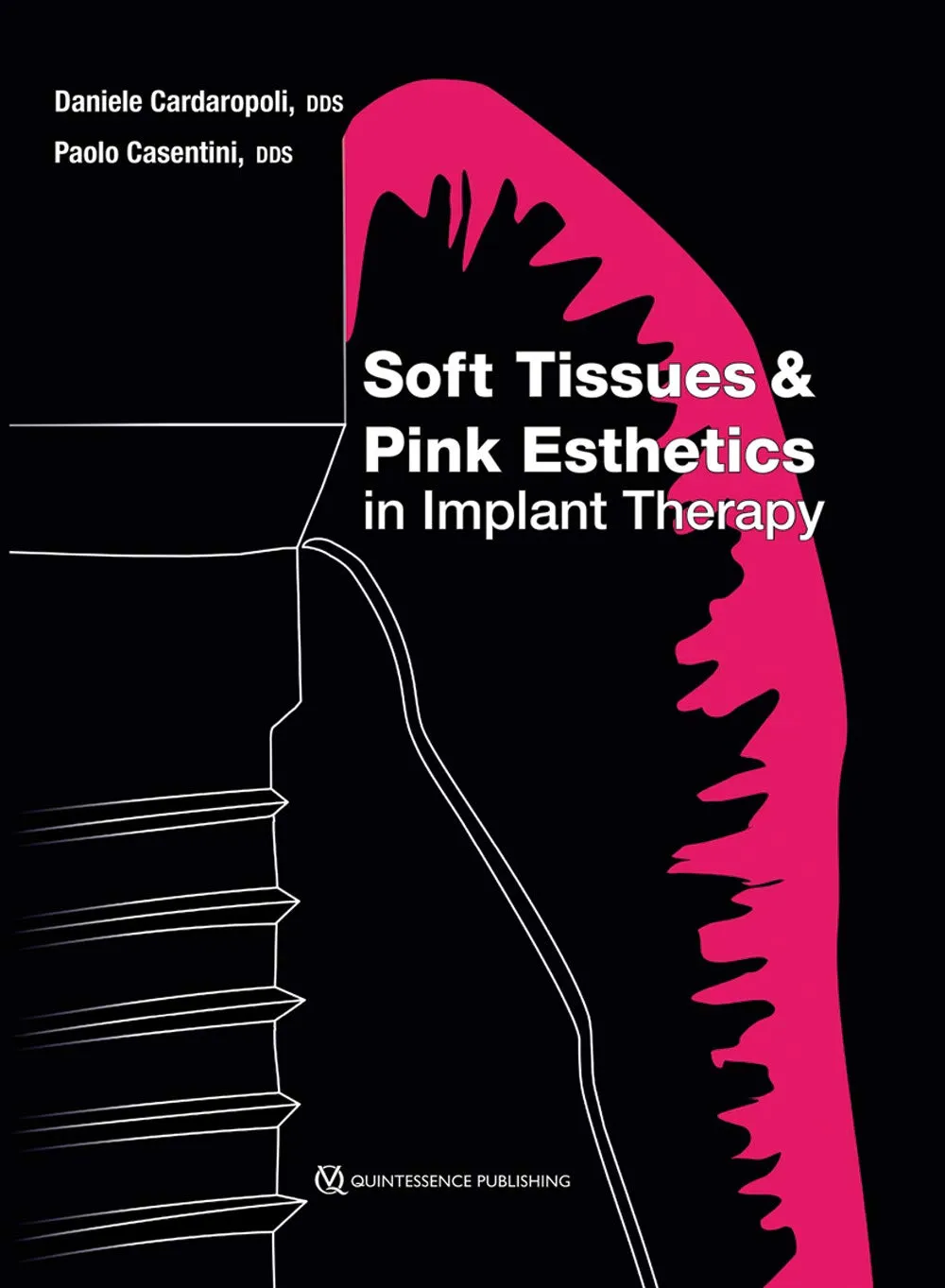 Soft Tissues and Pink Esthetics in Implant Therapy | Hardcover