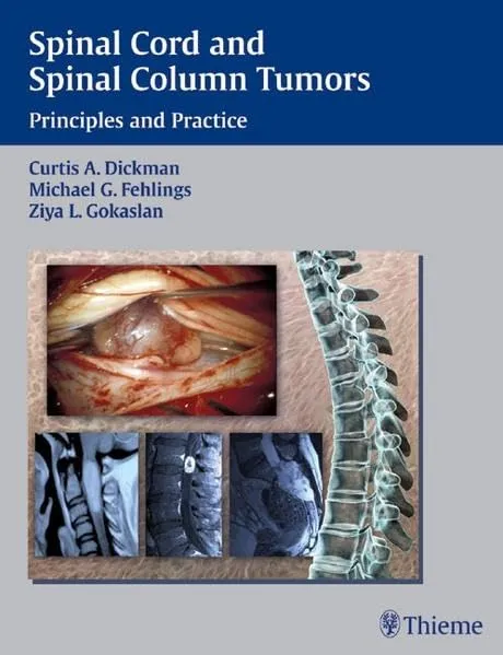 Spinal Cord and Spinal Column Tumors | Principles and Practice | Hardcover