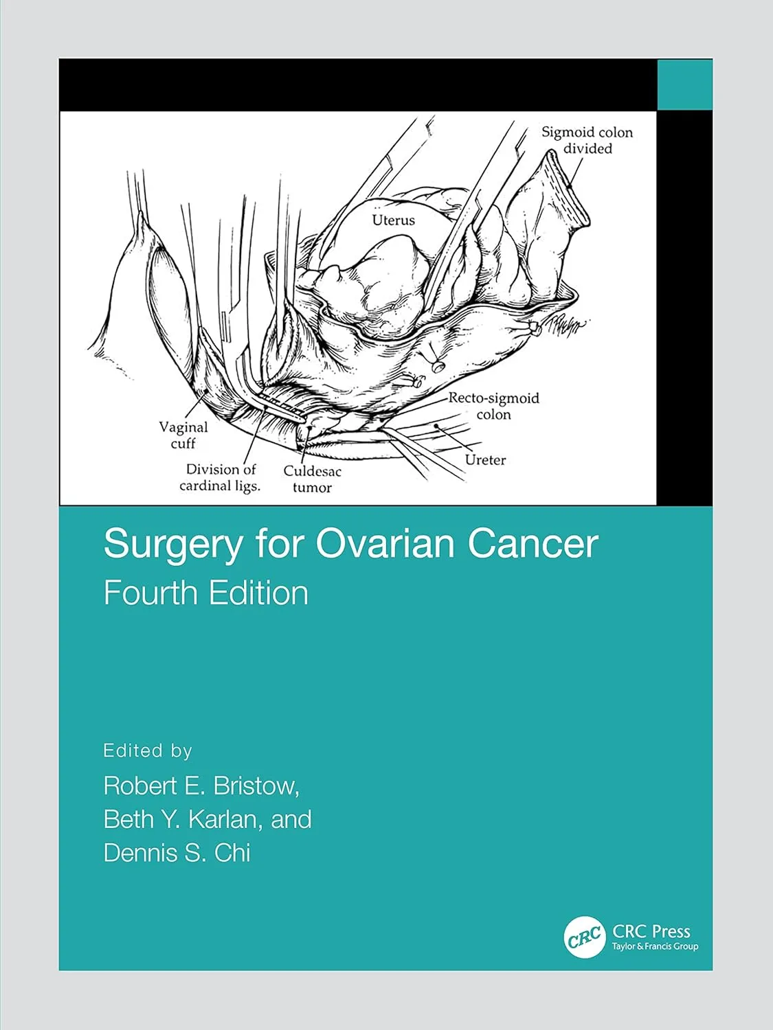 Surgery For Ovarian Cancer 4th Edition | Hardcover