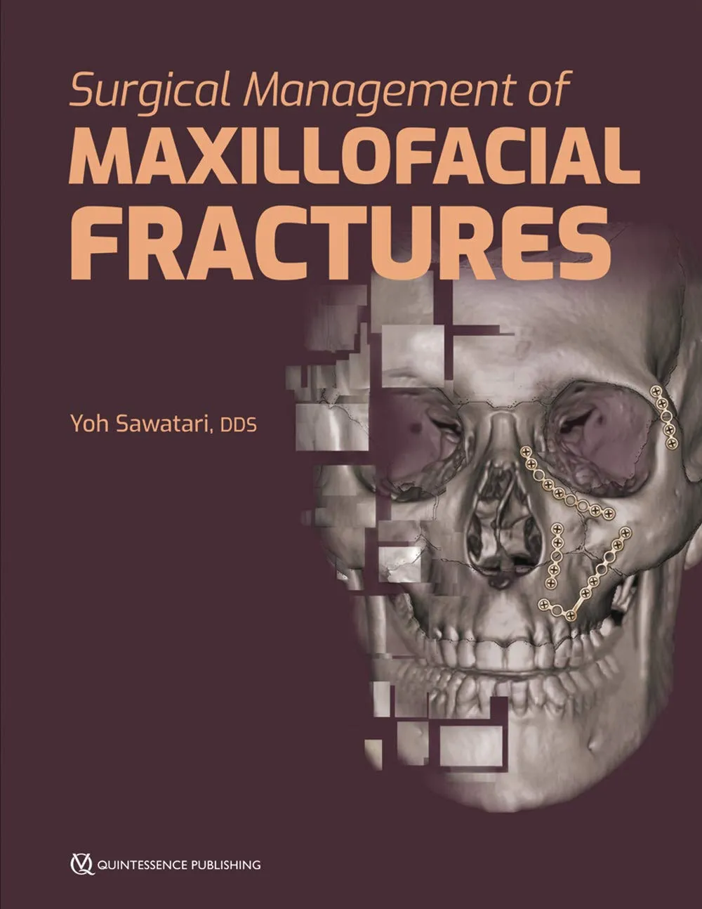 Surgical Management of Maxillofacial Fractures | Hardcover