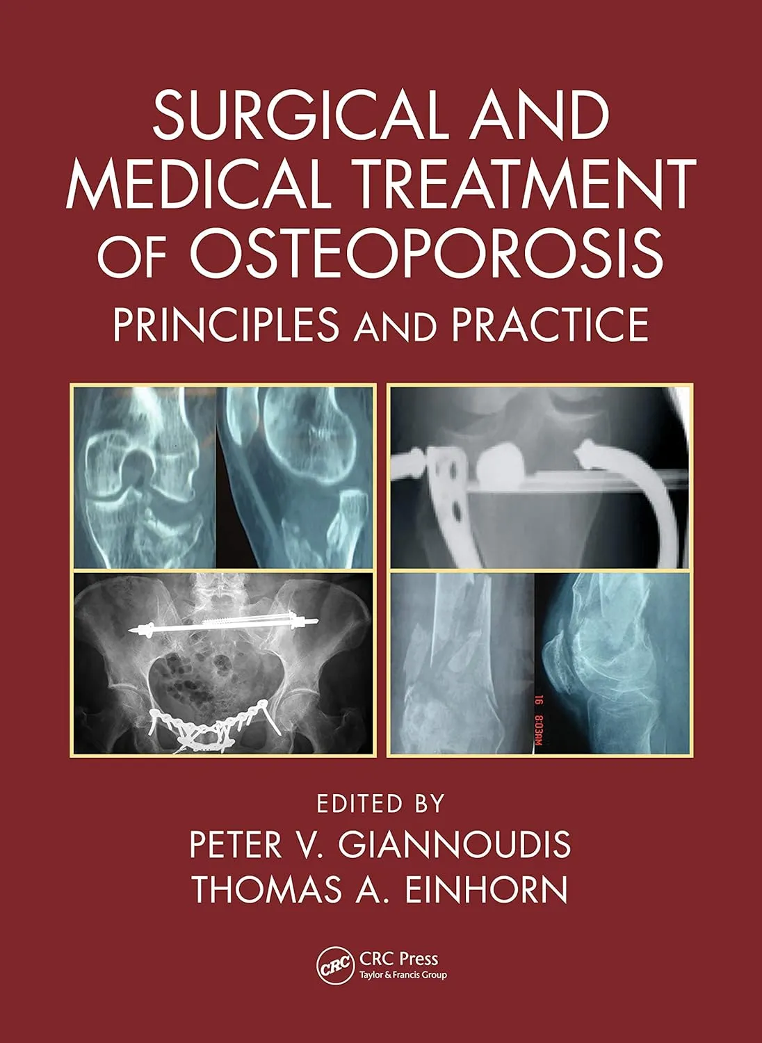 Surgical And Medical Treatment Of Osteoporosis Principles And Practice | Hardcover