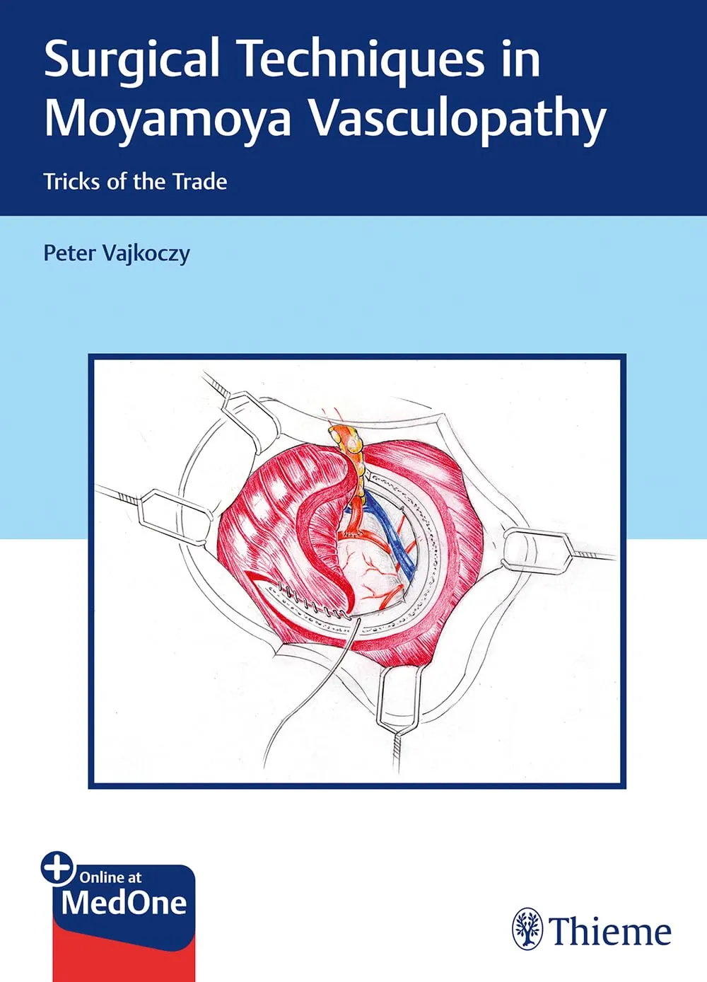 Surgical Techniques in Moyamoya Vasculopathy | Hardcover