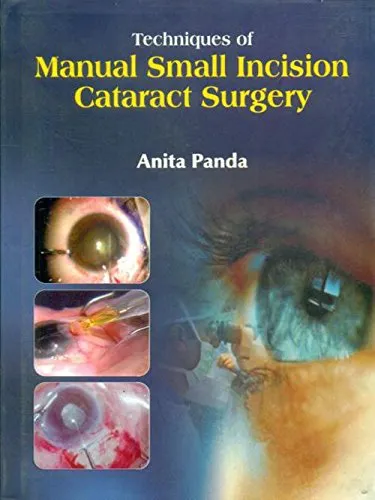 Techniques of Manual Small Incision Cataract Surgery | Hardcover