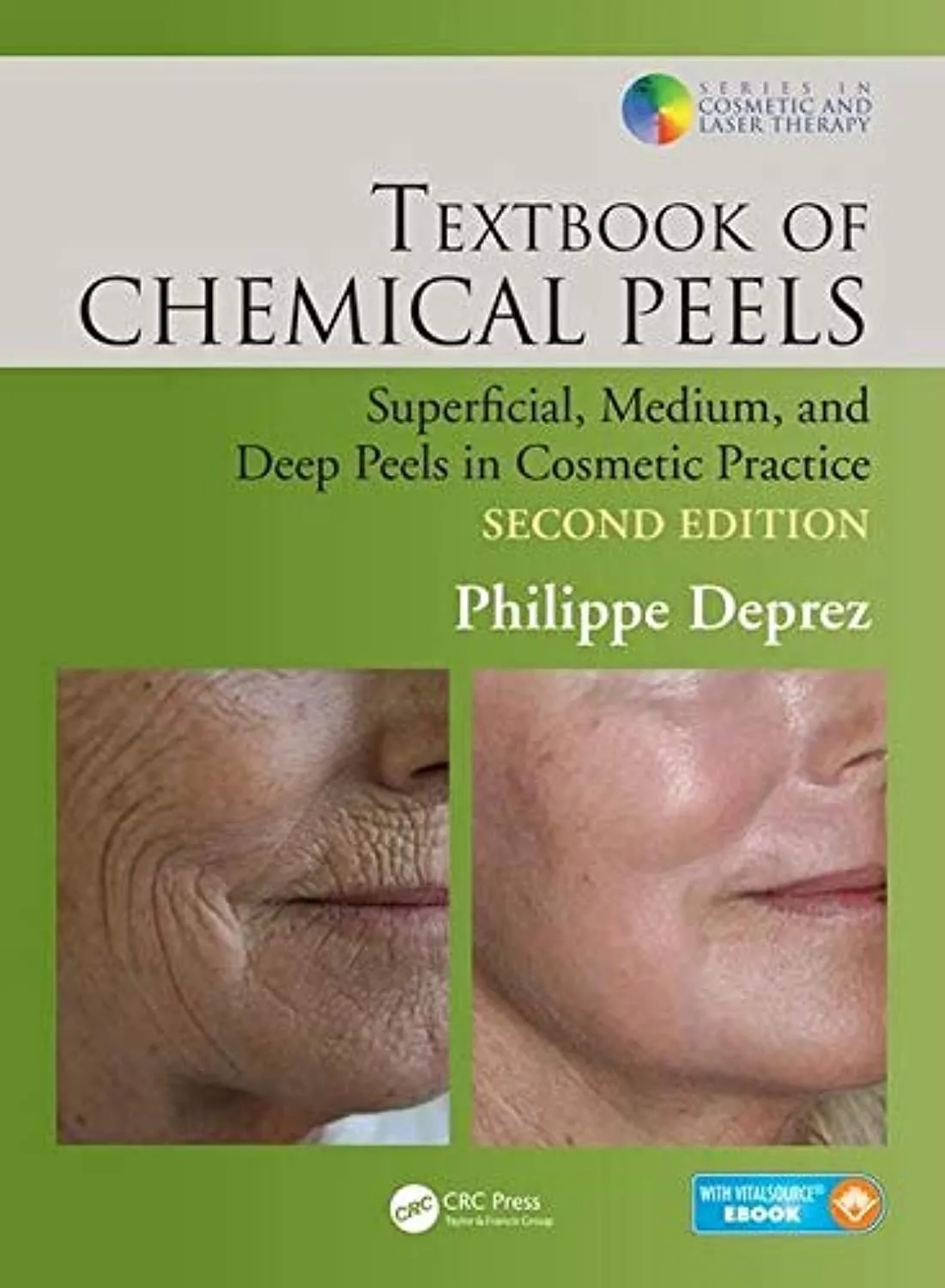 Textbook of Chemical Peels | 2nd Edition | Hardcover