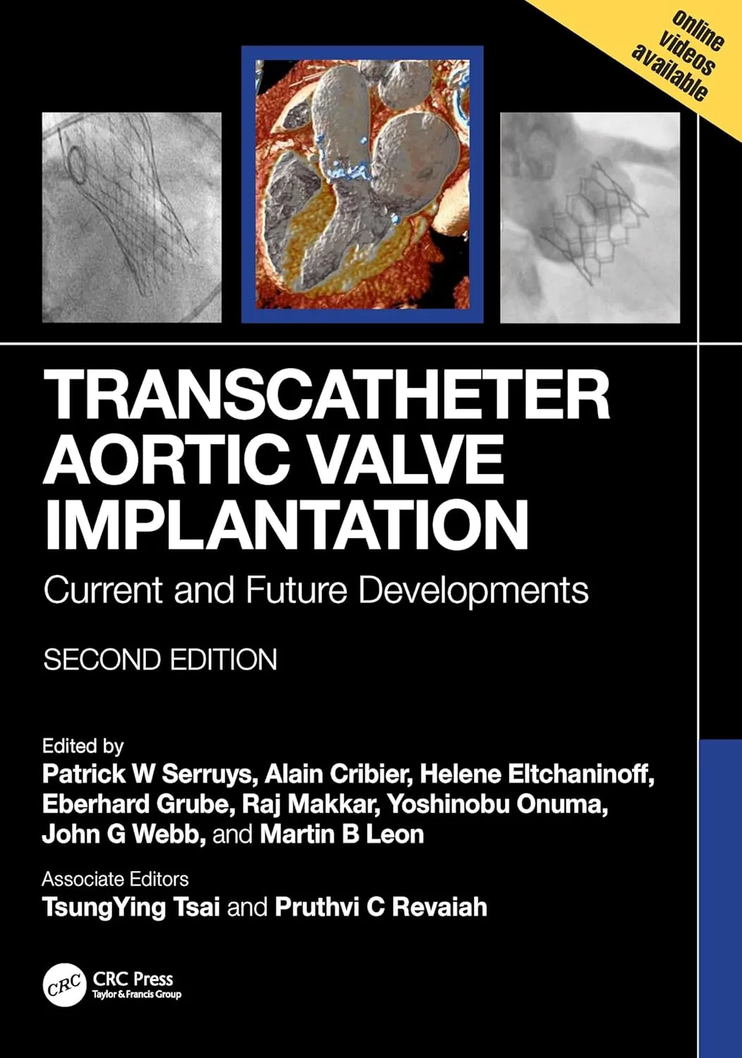 Transcatheter Aortic Valve Implantation Current and Future Developments | 2nd Edition | Hardcover