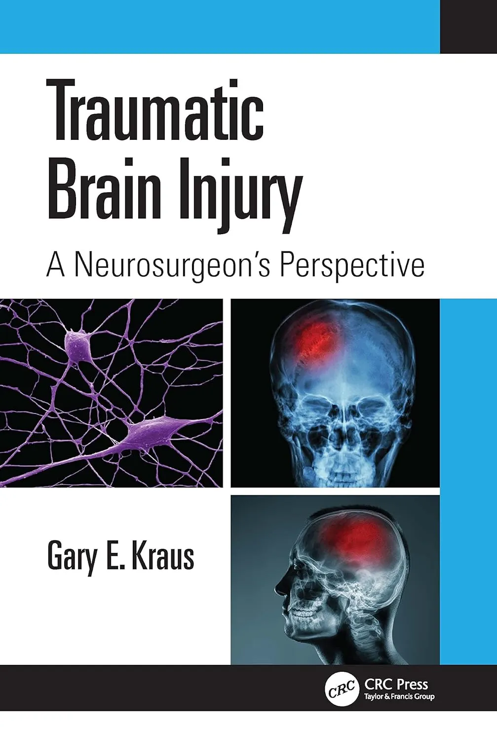 Traumatic Brain Injury A Neurosurgeons Perspective | Paperback