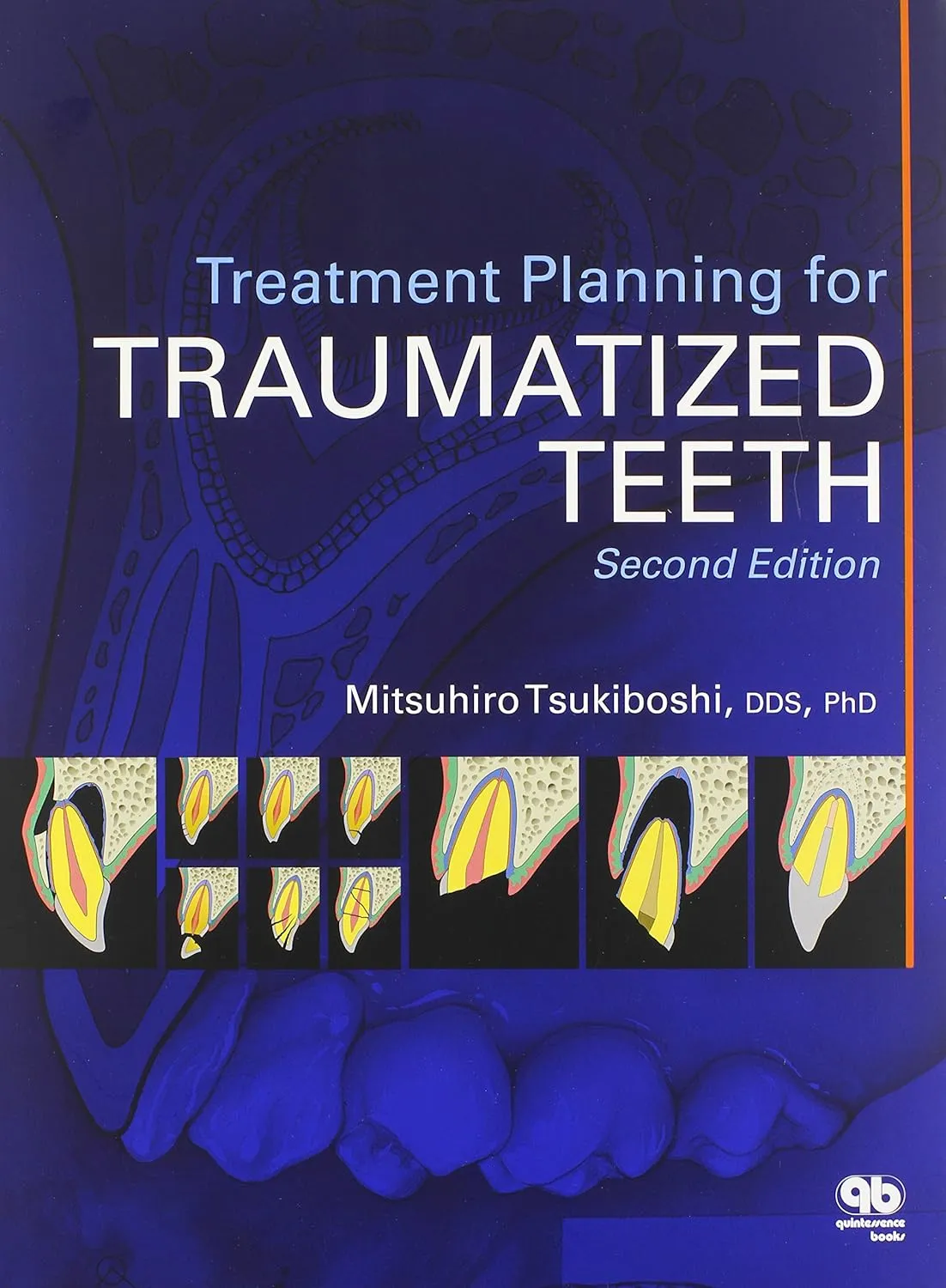Treatment of Planning for Traumatized Teeth | 2nd Edition | Paperback