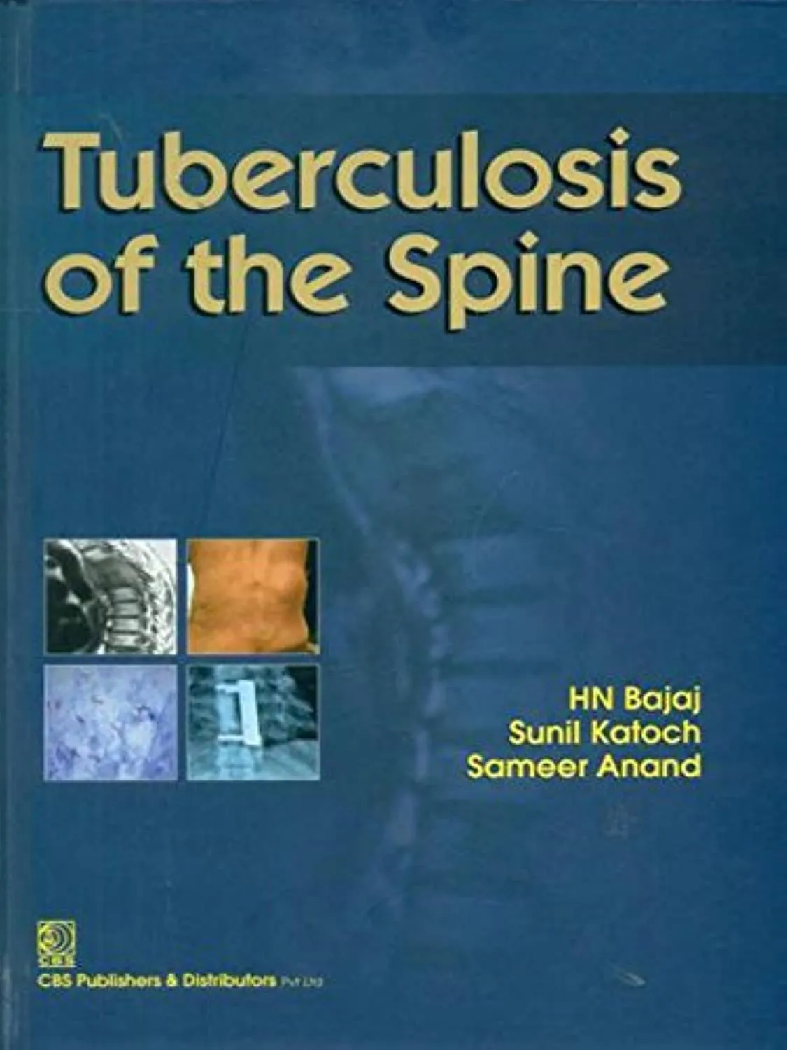 Tuberculosis of the Spine | Hardcover