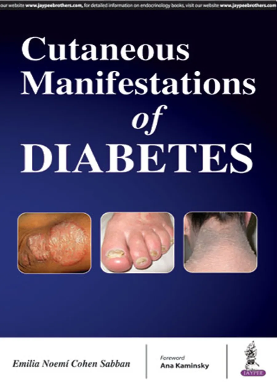 Cutaneous Manifestations Of Diabeties | Paperback