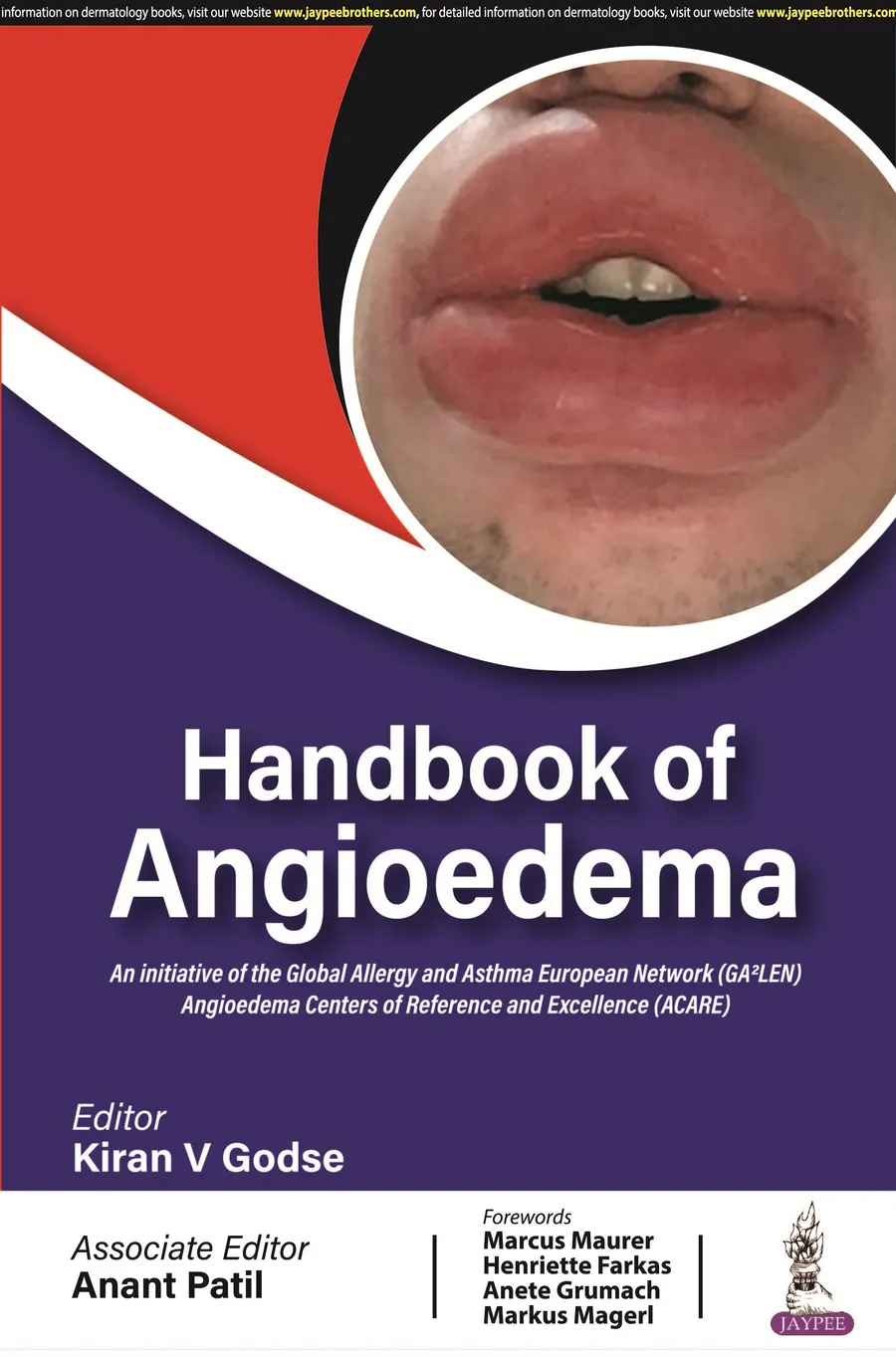 Handbook Of Angioedema | Paperback