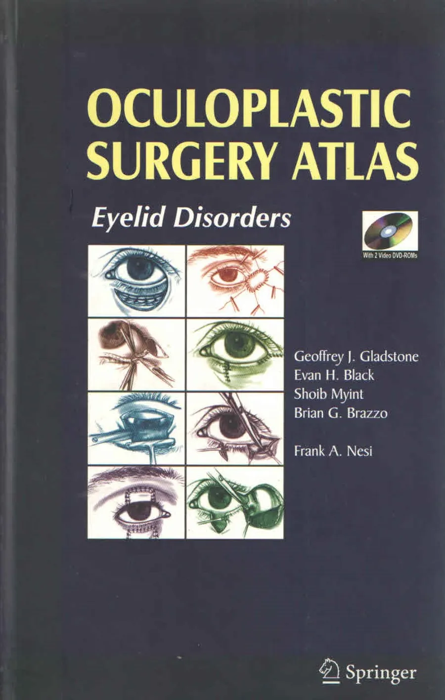 (Ex)Oculoplastic Surgery Atlas Eyelid Disorders With 2 Video Dvd-Roms