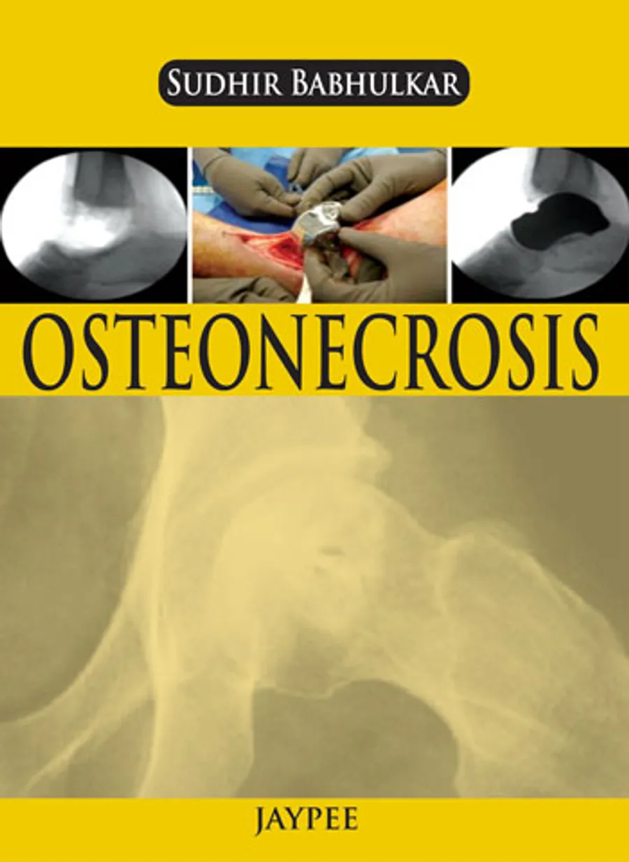 Osteonecrosis | Paperback