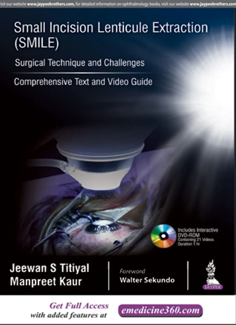 Small Incision Lenticule Extraction (Smile) Surgical Technique And Challenges:Comprehensive Text | Hardcover