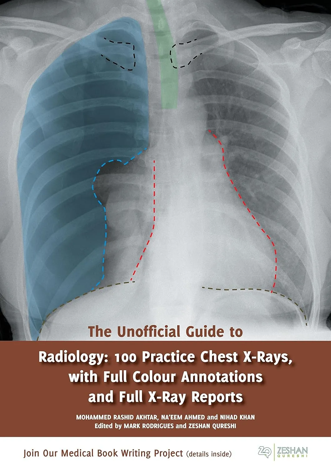 The Unofficial Guide to Radiology 100 Practice Chest X-Rays | With Full Colour Annotations and Full X-Ray Reports | Paperback