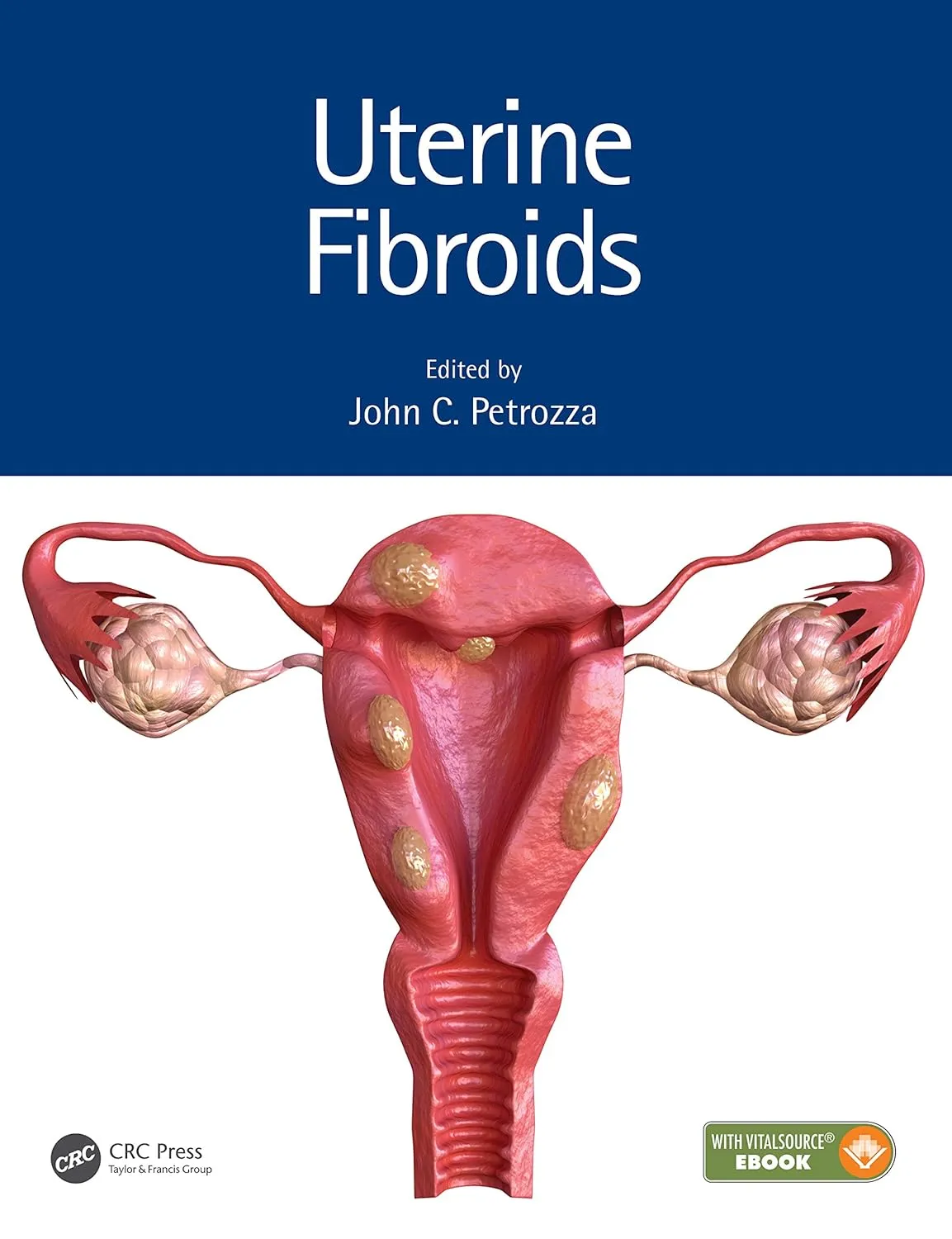 Uterine Fibroids | Hardcover