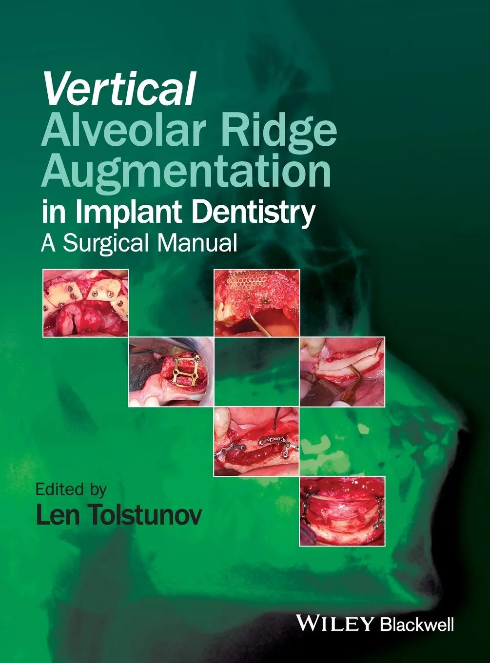Vertical Alveolar Ridge Augmentation in Implant Dentistry | Hardcover