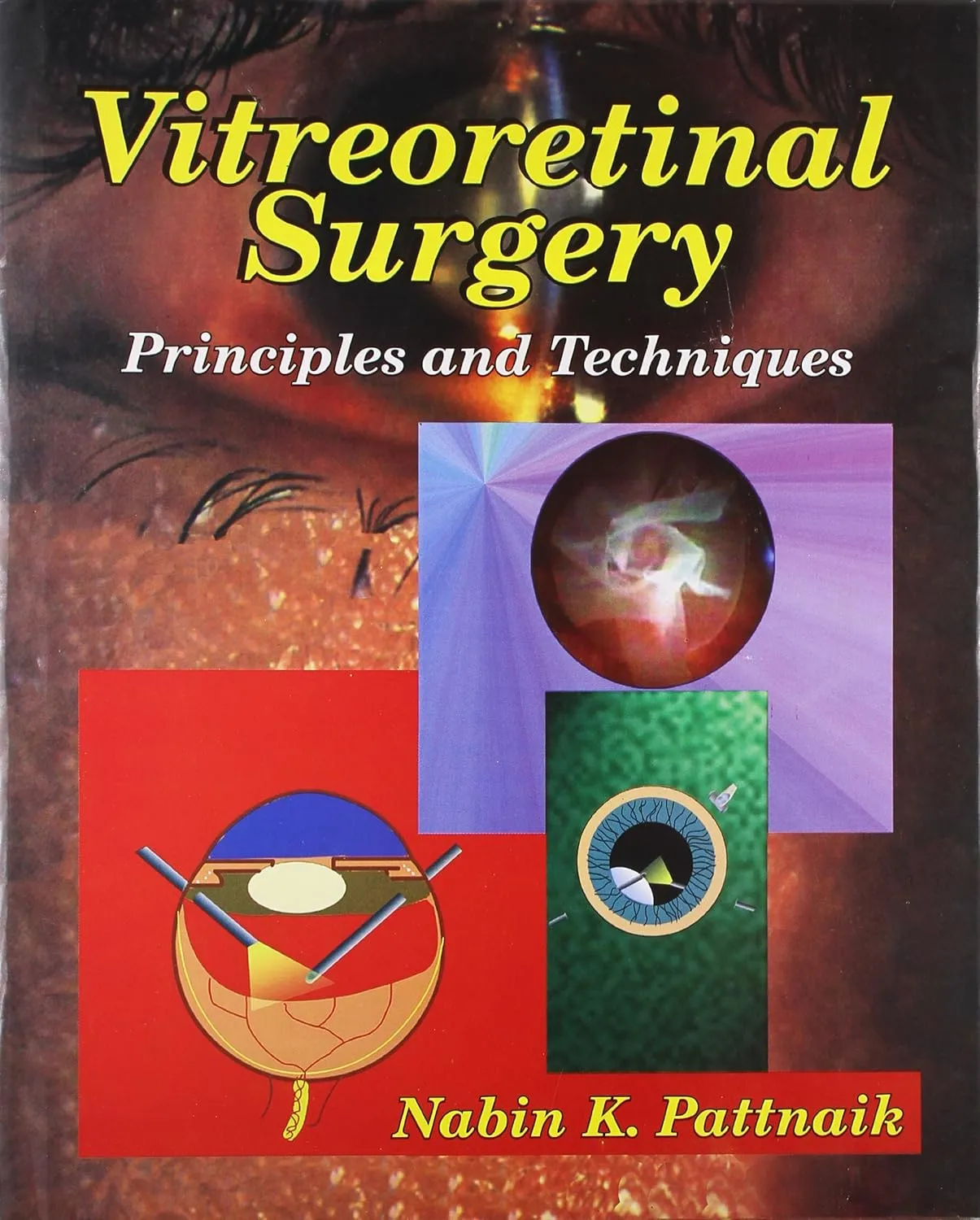 Vitreoretinal Surgery Prin. and Techniques