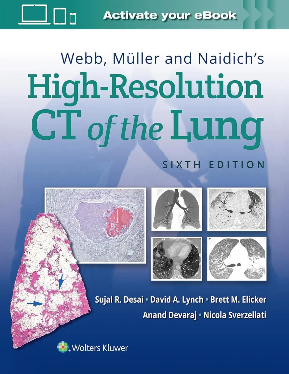 Webb Muller And Naidichs High Resolution Ct Of The Lung 6th Edition | Hardcover