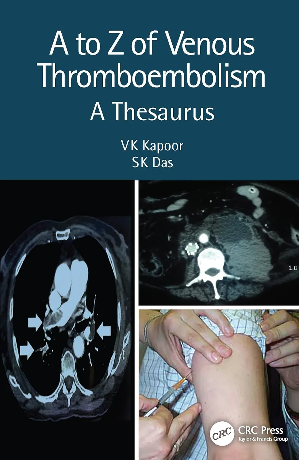 A To Z of Venous Thromboembolism A Thesaurus 2nd Edition | Paperback