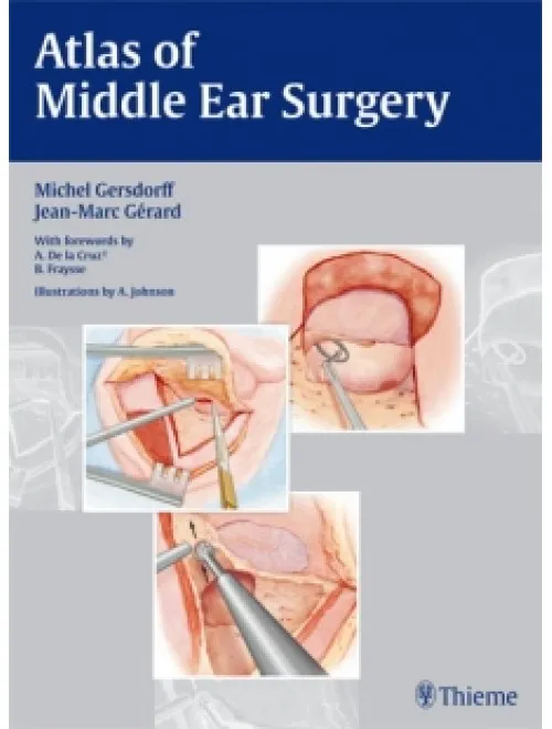 Atlas of Middle ear Surgery - 1st Edition
