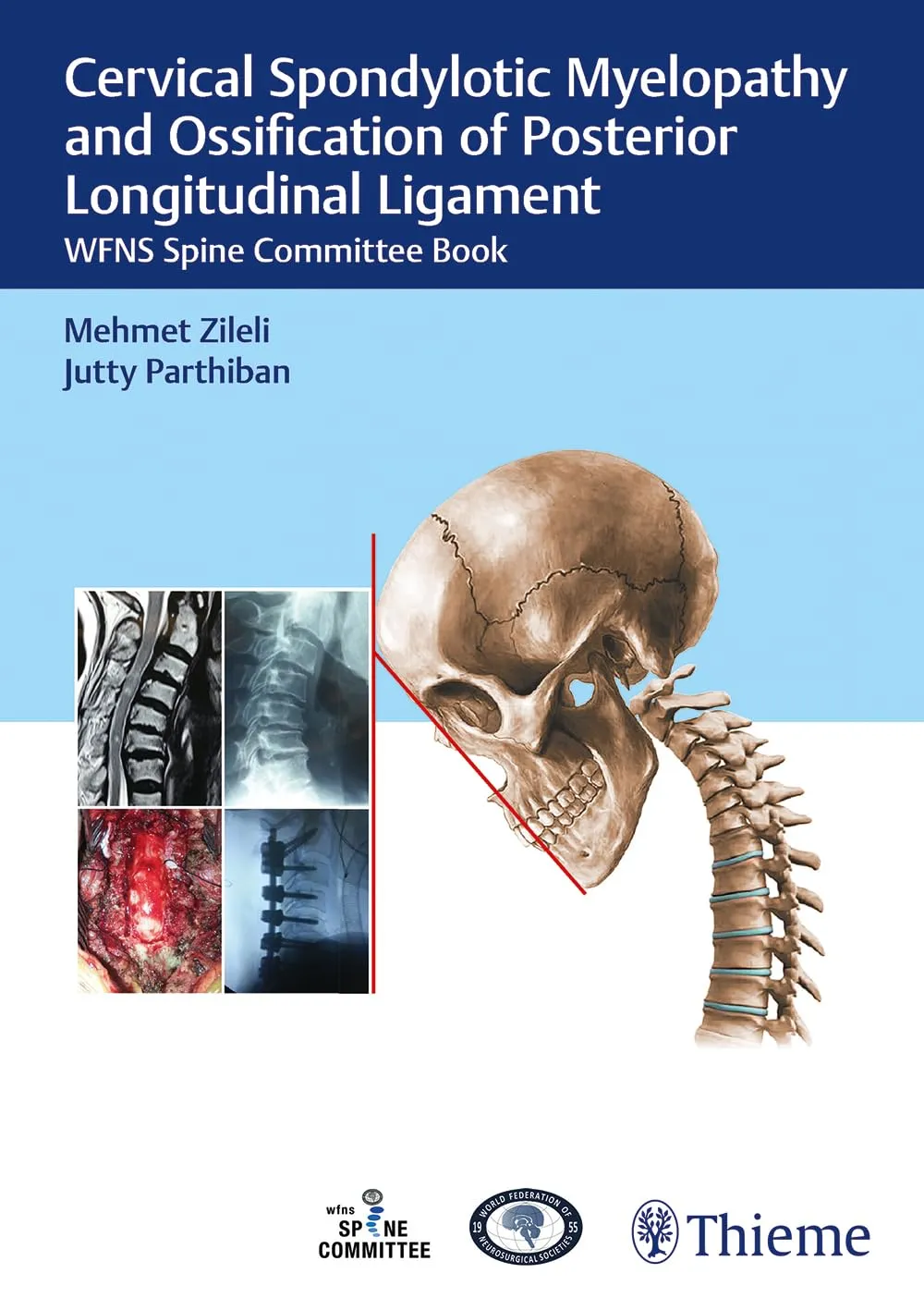 Cervical Spondylotic Myelopathy and OPLL 1st Ed.