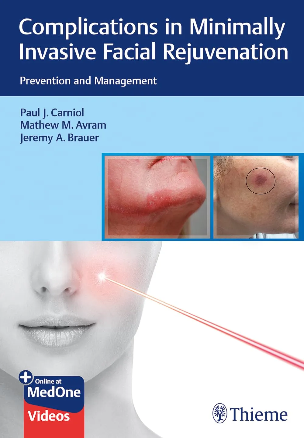Complications in Minimally Invasive Facial Rejuvenation 1st Ed.