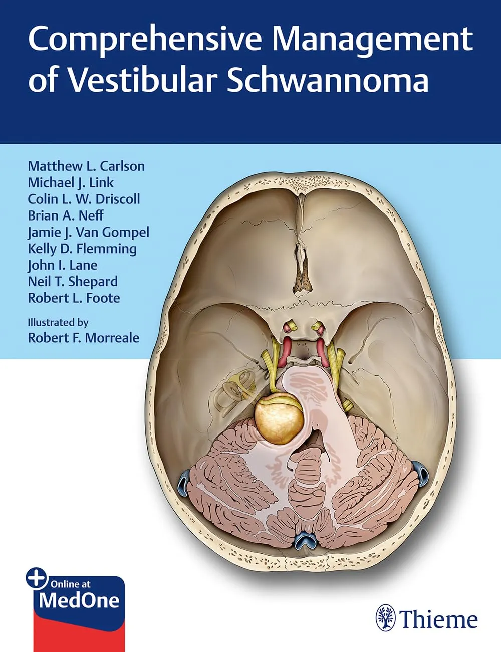 Comprehensive Management of Vestibular Schwannoma 1st Ed.