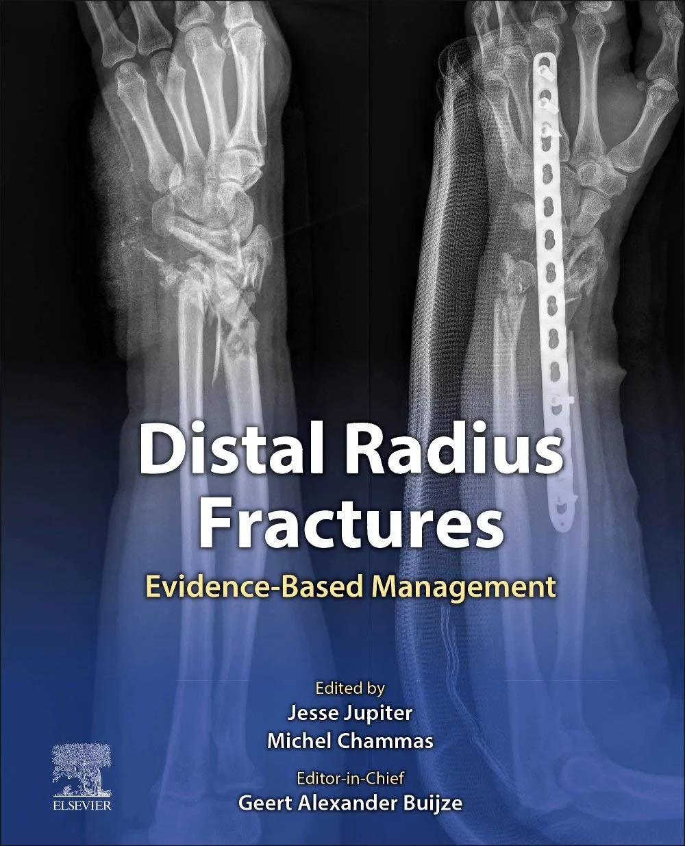 Distal Radius Fractures-1E