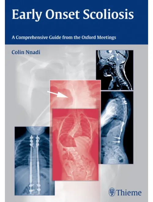 Early Onset Scoliosis A Comprehensive Guide from the Oxford Meetings - 1st Edition
