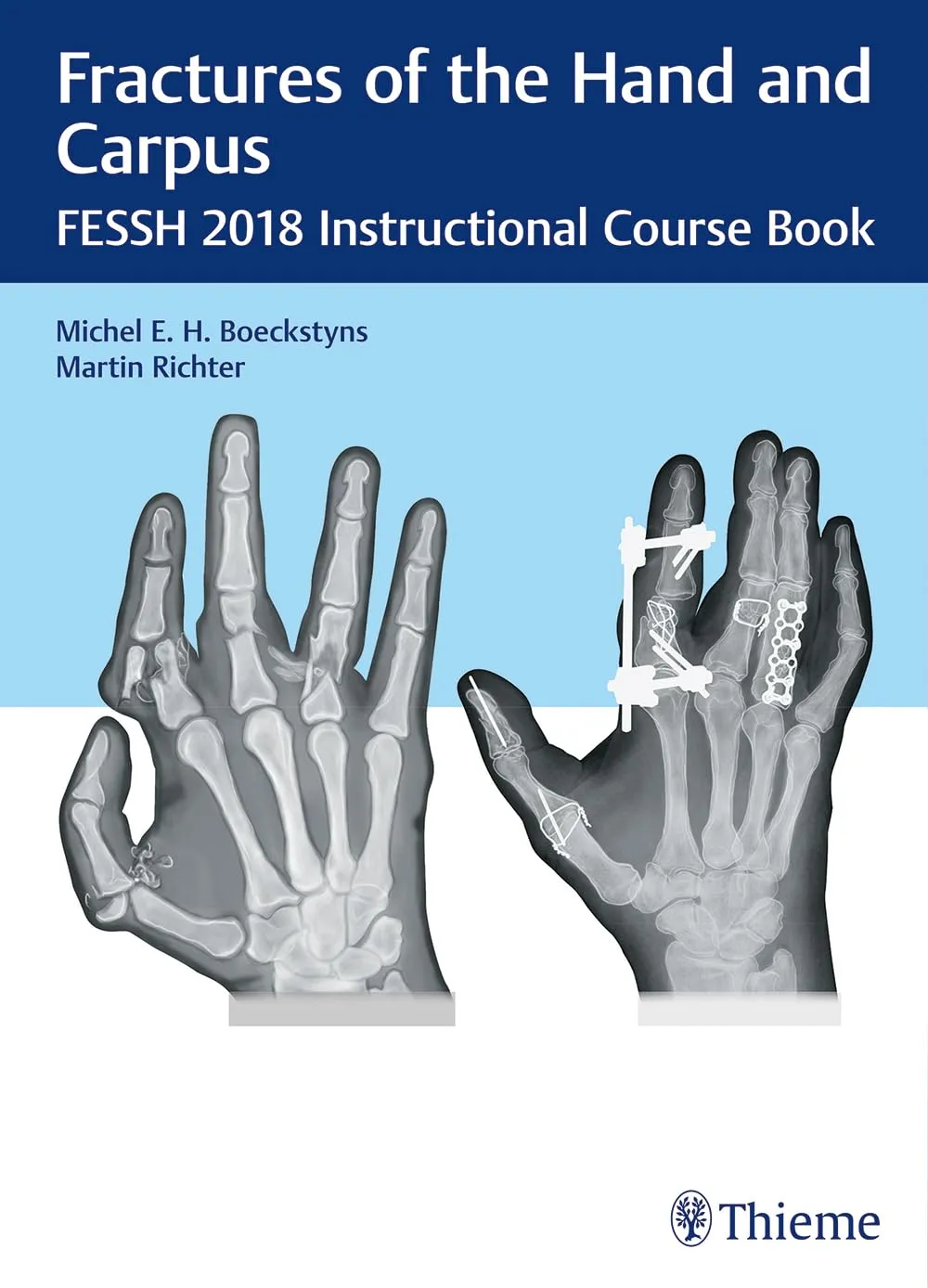 Fractures of the Hand and Carpus Fessh 2018 Instructional Course Book