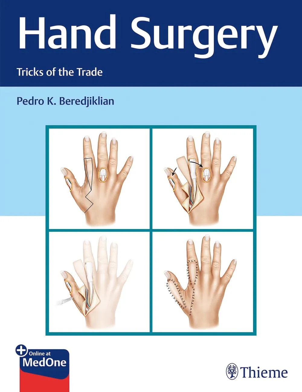 Hand Surgery : Tricks of the Trade 1st Ed.