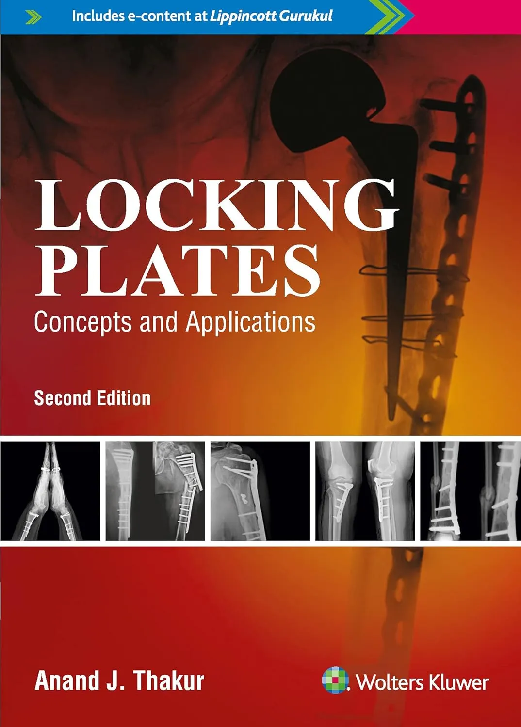 Locking Plates Concepts and Applications -2E