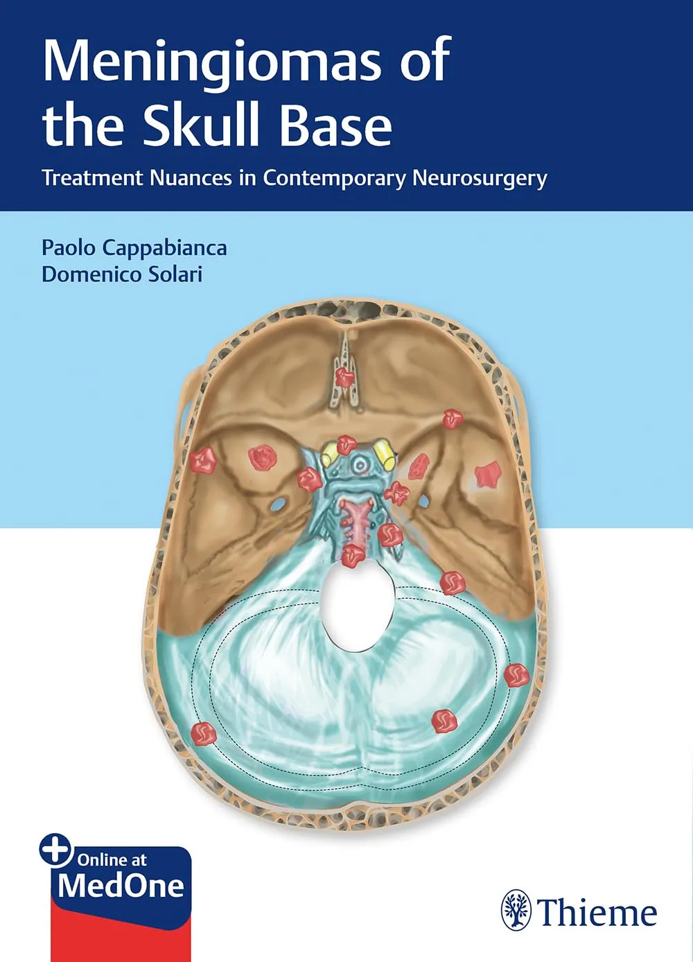 Meningiomas of the Skull Base 1st Edition