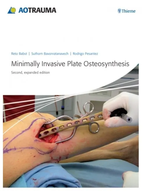 Minimally Invasive Plate Osteosynthesis (MIPO) - 2nd Edition