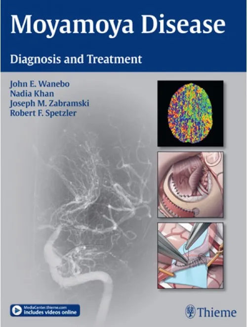 Moyamoya Disease - Diagnosis and Treatment - 1st Edition